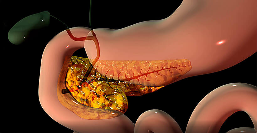 Pankreas Bauchspeicheldrüse, Bauchspeicheldrüsenkrebs, Ansicht Illustration