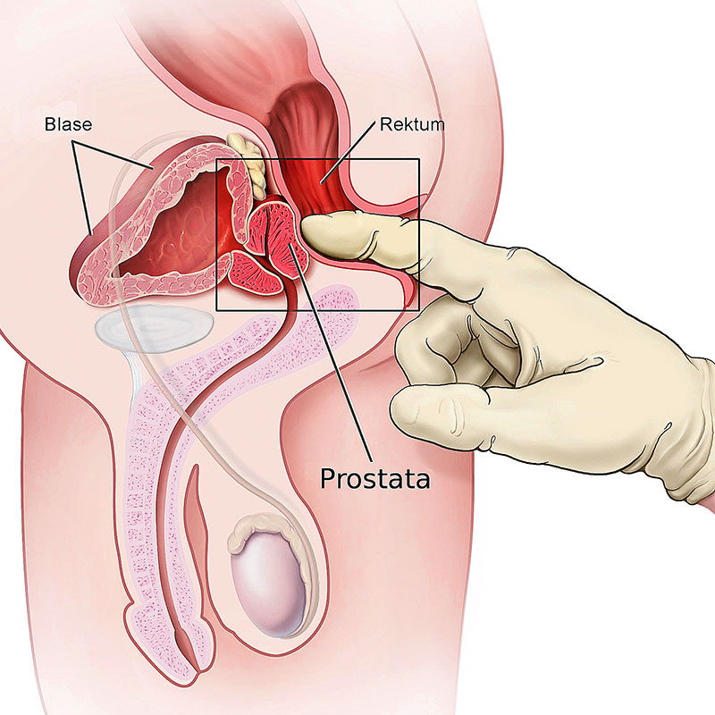 Rektale Tastuntersuchung der Prostata, Prostatakrebs Vorsorgeuntesuchung