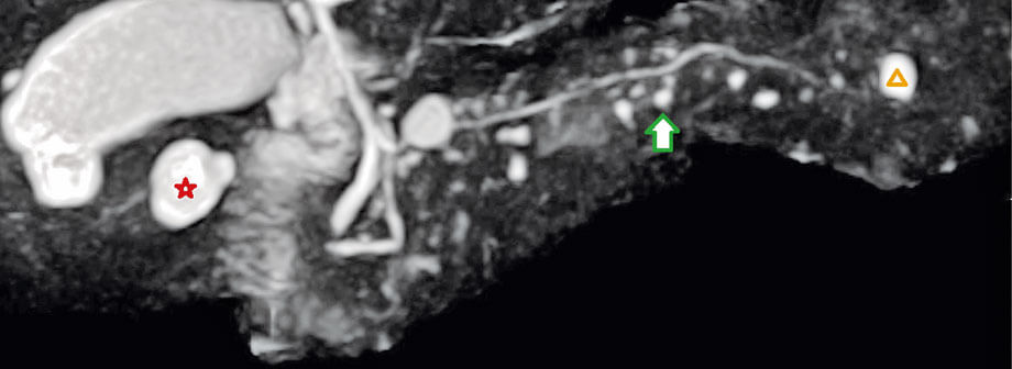 Abbildung MRT Zystische Tumore des Pankreas